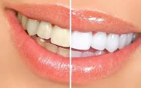 Blanqueamiento dental 